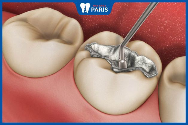 Trám răng có đau không, cách chăm sóc sau khi trám răng